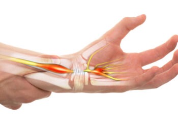 Sindromul de tunel carpian