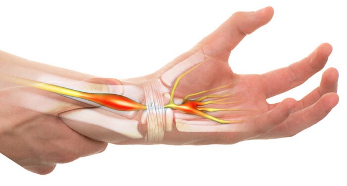 Sindromul de tunel carpian