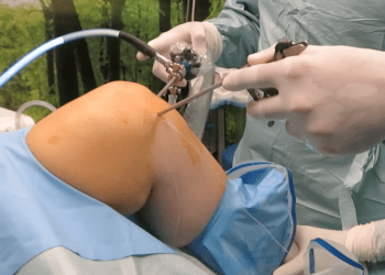 Recuperarea genunchiului după ligamentoplastie