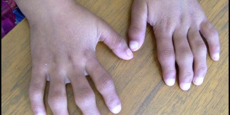 Artrita idiopatică juvenilă