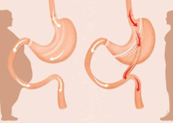 Micșorarea stomacului; creier mai mare, burta mai mică