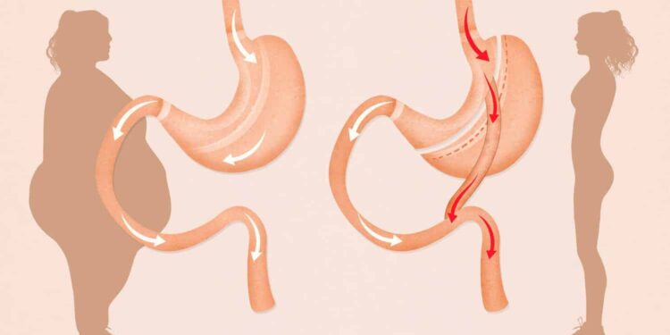 Micșorarea stomacului; creier mai mare, burta mai mică