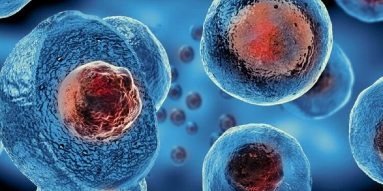 Transplantul de celule cerebrale încetinește o boală neurodegenerativă rară