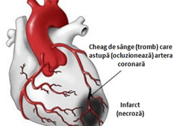 Mai mult de jumătate dintre infarctele miocardice la femeile tinere au cauze netradiționale