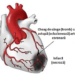 Mai mult de jumătate dintre infarctele miocardice la femeile tinere au cauze netradiționale