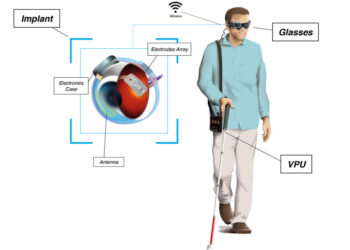 Implantul wireless subretinal îmbunătățește vederea centrală la degenerescența maculară uscată avansată