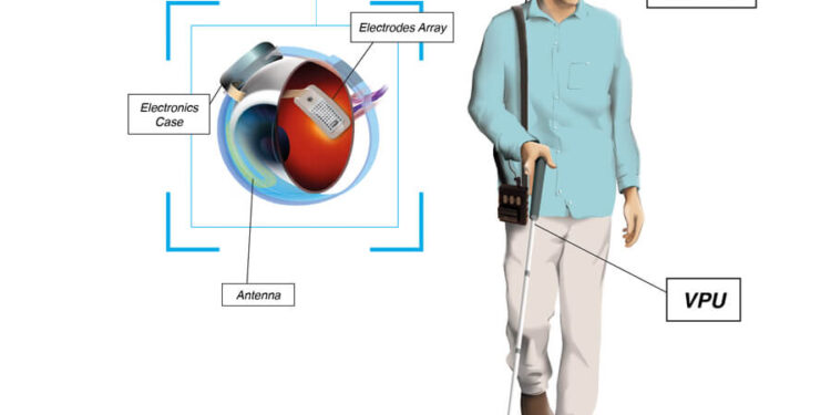 Implantul wireless subretinal îmbunătățește vederea centrală la degenerescența maculară uscată avansată