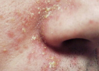 Dermatita seboreică legată de multiple boli ale barierei epiteliale într-un studiu din SUA