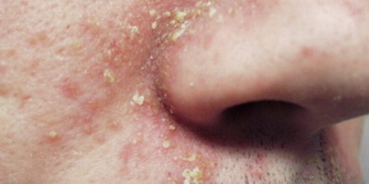 Dermatita seboreică legată de multiple boli ale barierei epiteliale într-un studiu din SUA