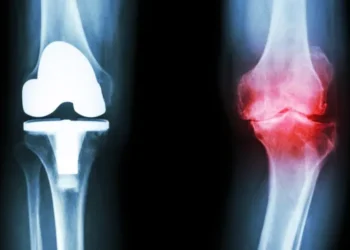 RMN-ul dezvăluie modificări structurale în timp la genunchi fără osteoartrită radiografică